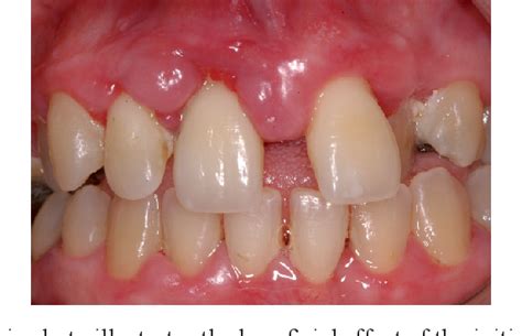 Figure 1 From Severe Phenytoin Induced Gingival Enlargement Associated