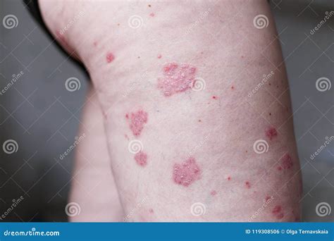 Pelle Impetuosa Allergica Delleczema Della Dermatite Sulla Gamba Del