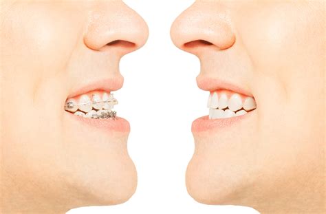 Before And After Orthodontic Treatment With Braces Valderrama