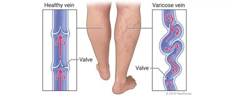 Everything You Need To Know About Varicose Veins Vein And