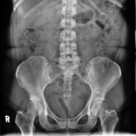 Tampon on pelvis x-ray | Image | Radiopaedia.org