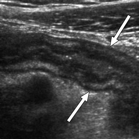 Diagnosing Acute Appendicitis In Adults Accuracy Of Color Doppler