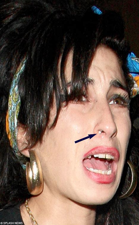 Amy Winehouse Teeth Before And After