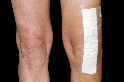 Knee Scars After Joint Replacement Photograph By Dr P Marazziscience Photo Library