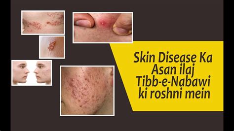 Skin Diseases Treatment In Tibb E Nabawi By Najm Rehan Youtube