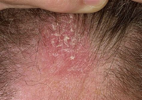 Dermatite S Borrh Ique Du Cuir Chevelu Comment La Traiter Bezzia