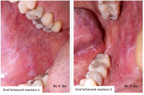 The Histopathological Difference Between Oral Lichen Planus And Oral