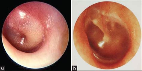 Comparative Assessment Of Grommets With Topical Intranasal Steroid In