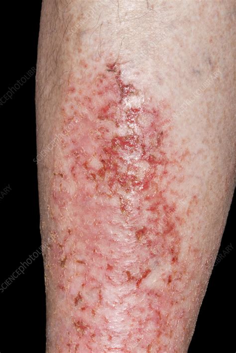 Infected Varicose Eczema Stock Image C0580825 Science Photo Library