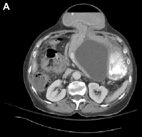 Acute Pancreatitis And Pseudocyst Due To A Closed Loop Obstruction From