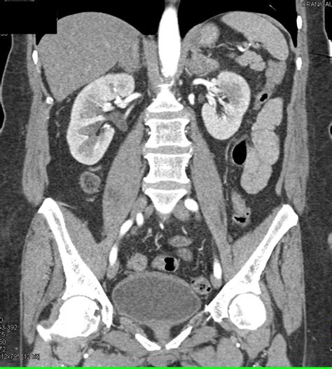 Bilateral Adrenal Hyperplasia Adrenal Case Studies Ctisus Ct Scanning