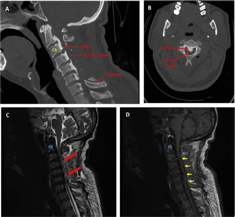 A Sagittal Section Of Ct Cervical Spine Red Arrows Are Used To Label