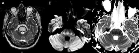 E Central Pontine Myelinolysis Axial T Wi A Shows Central