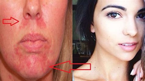 Home Remedies For Perioral Dermatitis Get Rid Red Bumps Around The