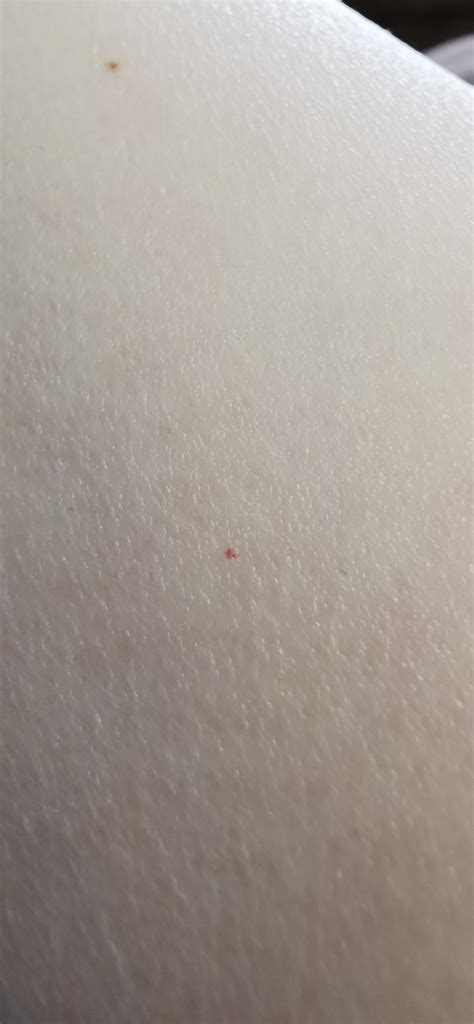 What Are These Pinpoint Red Dots On My Arm Rdermatology
