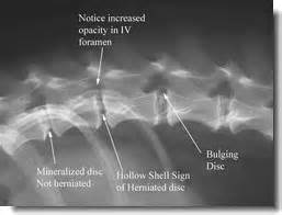 Here are some answers… intervertebral disc disease occurs when the discs (or shoc. "Slipped Disc" Disease In Dogs