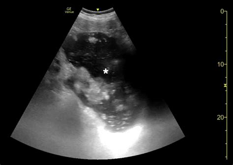 Cureus Emergency Physician Performed Bedside Ultrasound Of Gastric