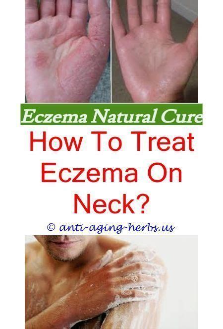 In infancy, the most common areas affected by. baby eczema pictures causes of eczema on hands and feet ...