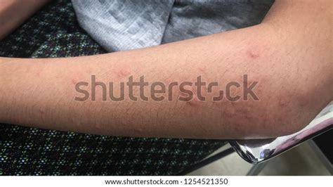 Urticarial Rash Left Arm Case Food Stock Photo 1254521350 Shutterstock