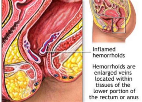 What Do Hemorrhoids Look Like Internal External HubPages