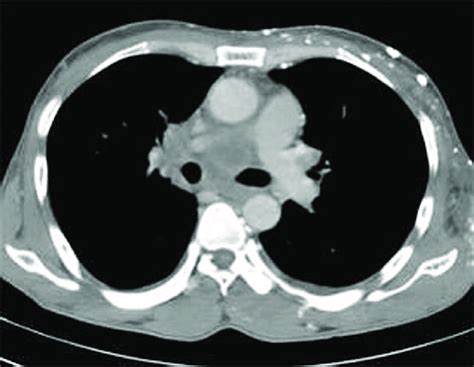Axial Contrast Enhanced Computed Tomography Image Demonstrating