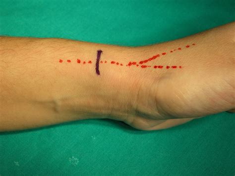 Σύνδρομο De Quervain Hand Surgery