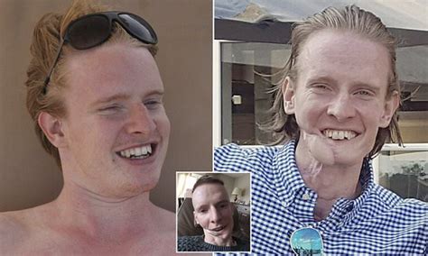 Belgian Cancer Survivor Uses His Back Fat To Rebuild Jaw Daily Mail