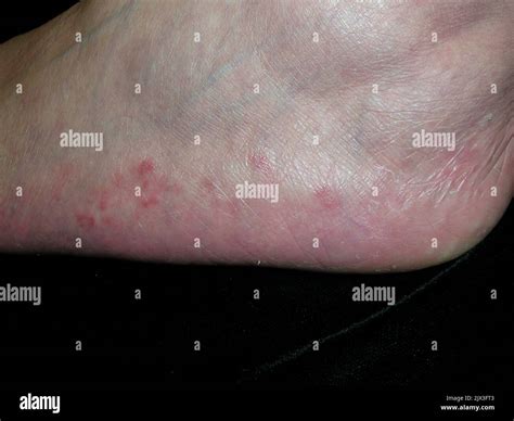 Rash On The Foot Of A Patient With Majocchis Granuloma This Infection
