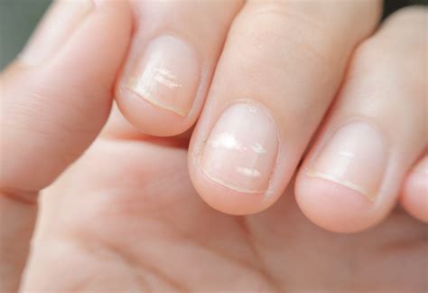Irregular white spots on nails (called leukonychia) are usually caused by minor impact damage to the nail bed. White Spots On Your Child's Nail - Should You Be Worried?