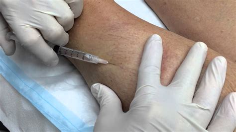Spider Vein Treatment Using Sclerotherapy Youtube