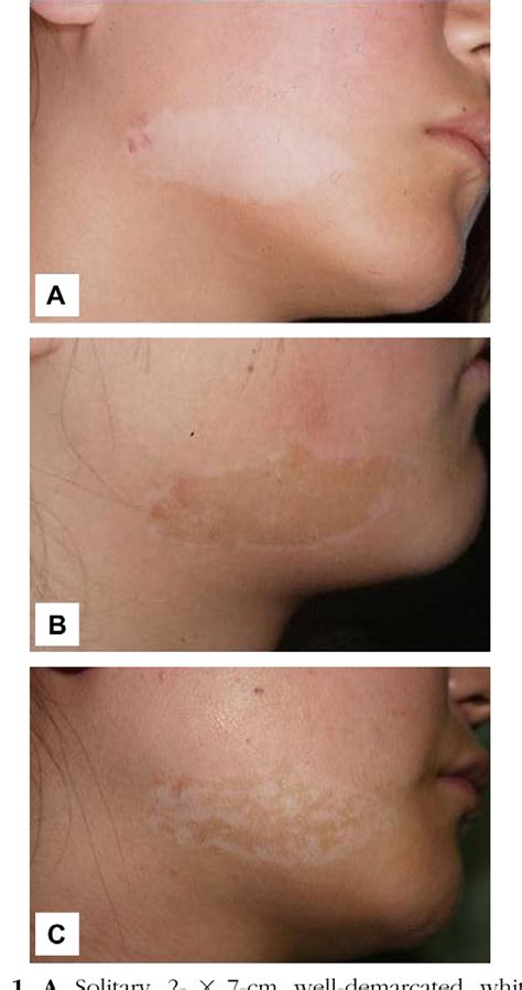 Figure 1 From Recurrence Of Nevus Depigmentosus After An Autologous