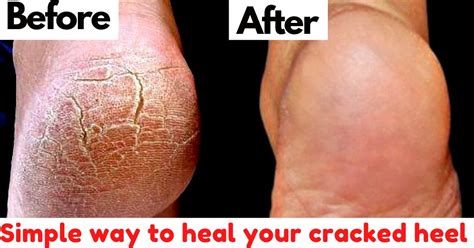 Natural And Easy Way To Heal Cracked Heels