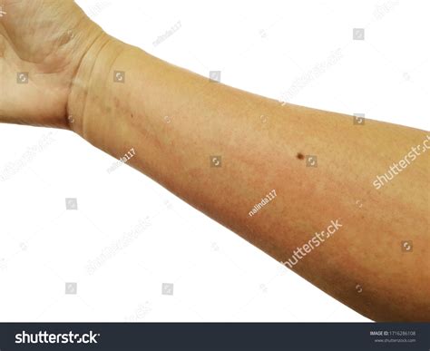 Allergic Rashes On Arm Skin Care Stock Photo 1716286108 Shutterstock