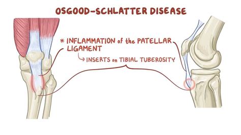 Osgood Schlatter Disease Traction Apophysitis Osmosis