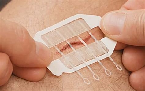 Zipstitch This Device Stitches You Up Without The Need For Stitches