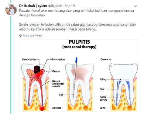 Gigi tercabut adalah perkara yang selalu berlaku dalam masyarakat. Doktor Ini Jelaskan Esen Vanila Bukan Penawar Sakit Gigi ...