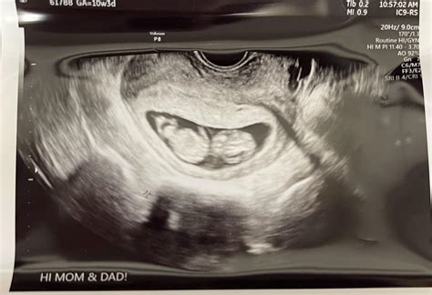 FTM with surprise twins! : r/parentsofmultiples