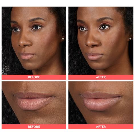 Lip Filler Before And After Feel Ideal Med Spa Southlake Tx