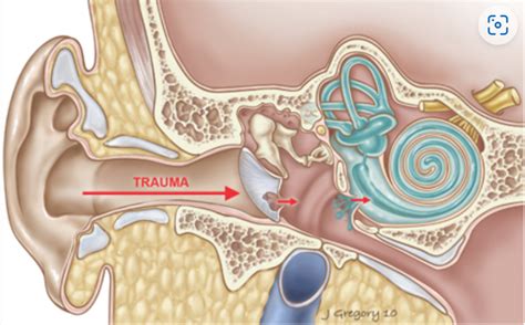 A Review On Traumatic Tympanic Membrane Perforations Sports Medicine