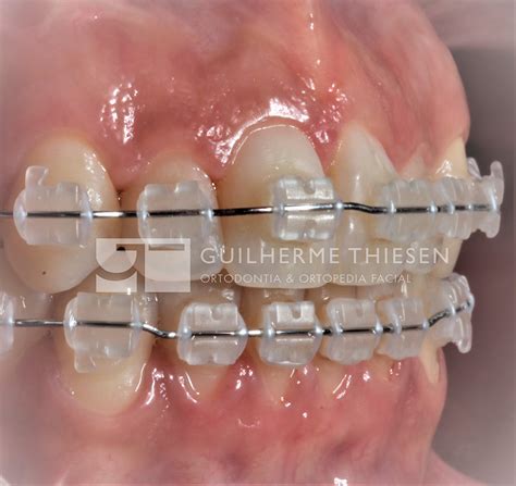 Entenda A Diferença Entre O Aparelho Cerâmico E O De Metal Thiesen Odontologia