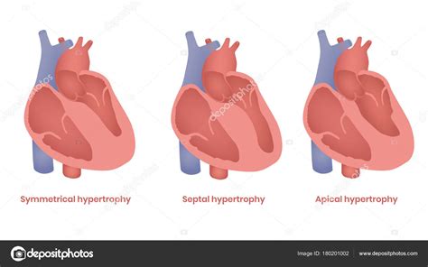 La miocardiopatía hipertrófica es la causa más común de muerte súbita en pacientes jóvenes sin otra patología. Ilustración de la miocardiopatía hipertrófica. Tipos septales y apicales y simétricos — Vector ...