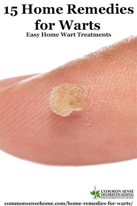 15 Home Remedies For Warts Cheap And Easy To Use These Home Wart