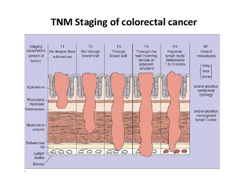 Colon Cancer Staging Chart