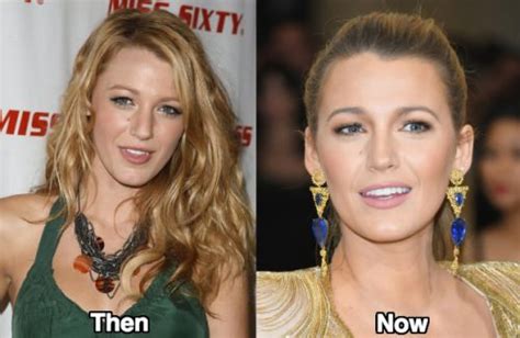 Blake Lively Nose Job Before And After Photos Latest Plastic Surgery Gossip And News Plastic