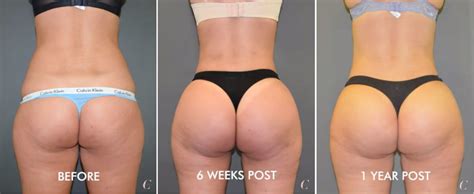 Brazilian Butt Lift Year Post Cosmetic Surgery Cosmos Clinic
