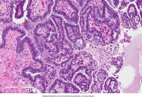 Pathology Outlines Seromucinous Cystadenoma