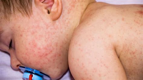 Dermatite At Pica Na Inf Ncia Diagn Stico E Tratamento Trendradars Portugu S