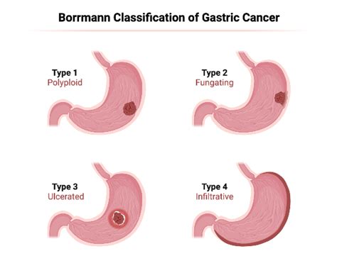 Borrmann Gastric Cancer Classification Biorender Science Templates