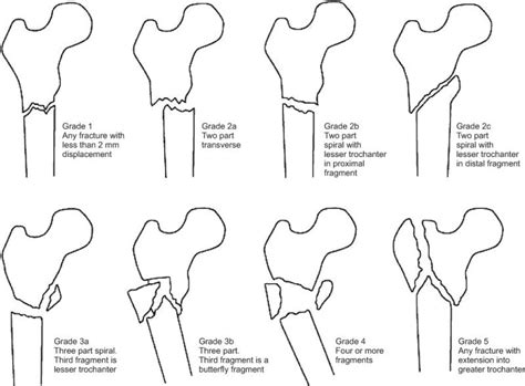 Avulsion fractures of the lesser trochanter, greater trochanter, and iliac crest are less common.3. Subtrochanteric Fractures Femur- Presentation and ...