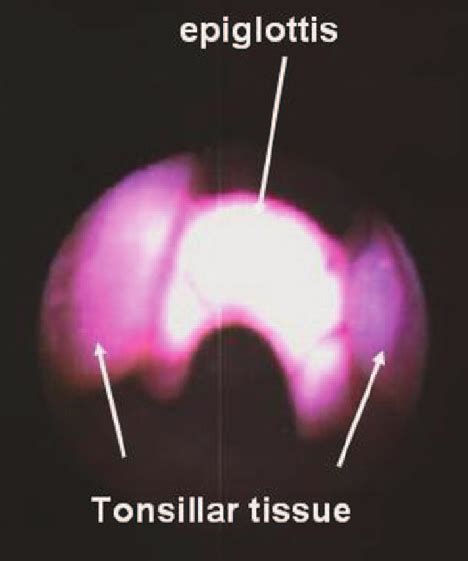 Tonsils The Lateral Masses In The Image Impinging On The Epiglottis